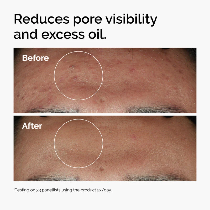 NIACINAMIDE 10% + ZINC 1%